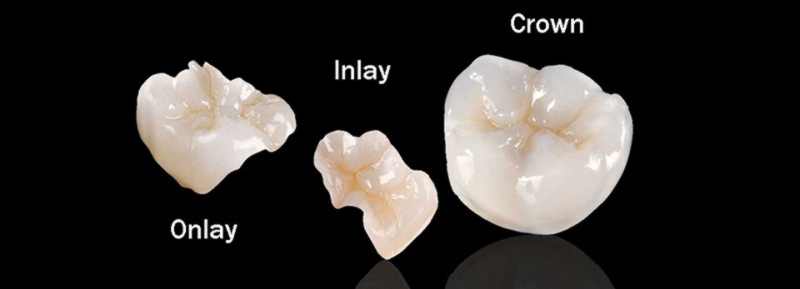 این روش ترمیم دندان برای پر کردن سطح جونده و مقداری از سطوح کناری دندان که در پشت دهان قرار میگیرند، طراحی شده است